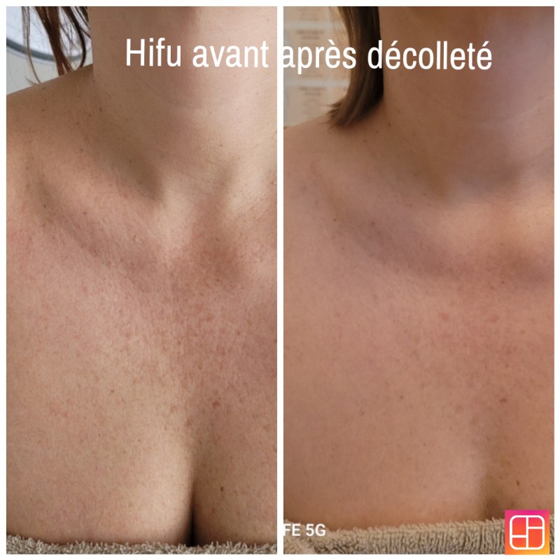 Un décolleté parfait pour cet été grâce à l HIFU en institut de beauté à Strasbourg proche Geispolsheim