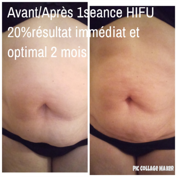 HIFU pour MAIGRIR du ventre à l'institut Anne Walter à Strasbourg