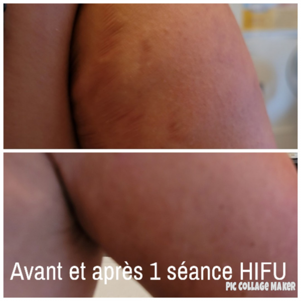 HIFU pour effacer efficacement les vergetures anciennes ou récentes à l'institut Anne Walter à Strasbourg