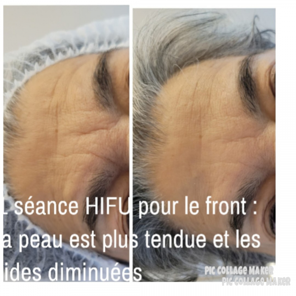 HIFU pour lisser le front et diminuer les rides pour rajeunir le visage naturellement à l'institut Anne Walter à Strasbourg