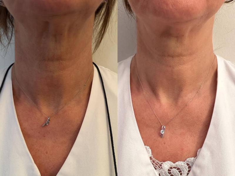 HIFU les Ultrasons Focalisés à Haute Intensité en institut de beauté à Strasbourg