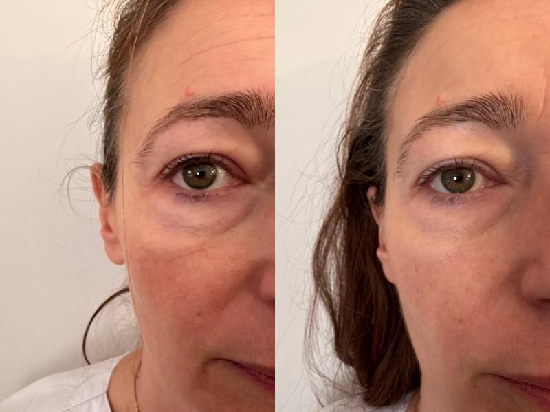 HIFU soin des yeux contre les poches, les rides et le relachement en institut de beauté à Strasbourg