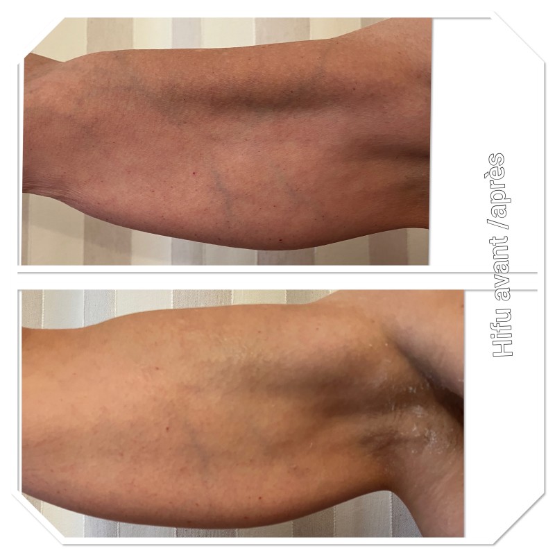  Découvrez l’efficacité de l’ Hifu sur la fermeté des bras ,  des cuisses du ventre et du visage, le meilleur des soins anti-âge à l’institut Anne Walter à Strasbourg