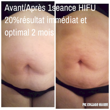 Notre zone d'activité pour ce service HIFU à Strasbourg dans le Bas-Rhin pour redessiner les contours du visage