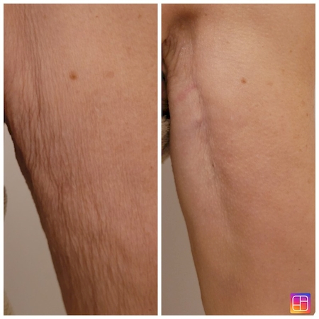 Notre zone d'activité pour ce service Solution pour retrouver des bras fermes et sans relâchement près de Schiltigheim en Alsace