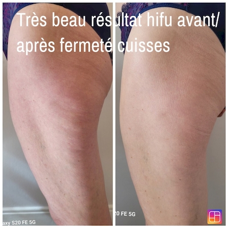 Notre zone d'activité pour ce service Solution pour retrouver des bras fermes et sans relâchement à Strasbourg dans le Bas-Rhin